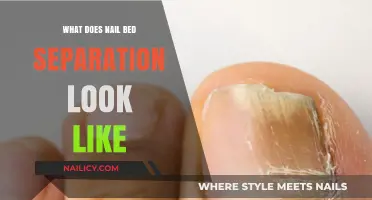 Understanding Nail Bed Separation: Visual Signs and Symptoms Explained