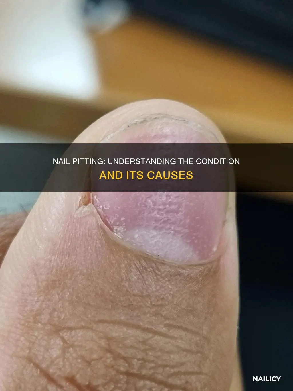 what does nail pitting mean