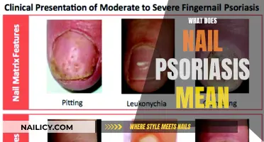 Nail Psoriasis: Understanding the Impact on Your Body