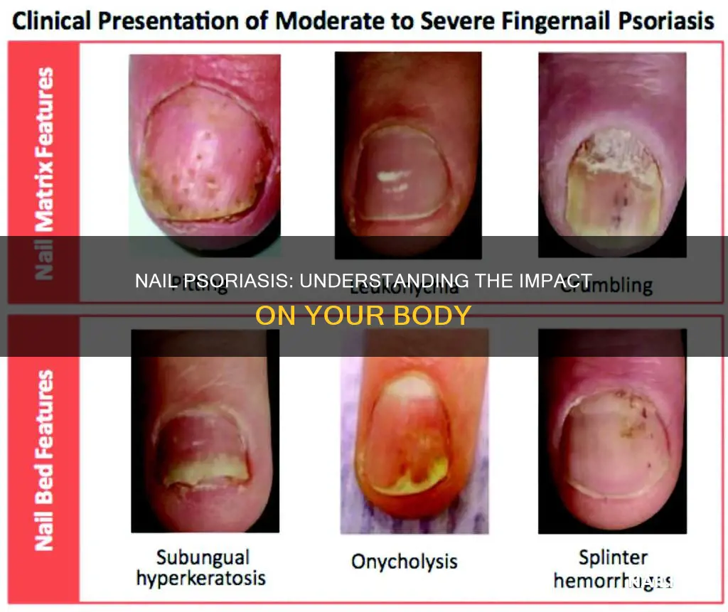 what does nail psoriasis mean