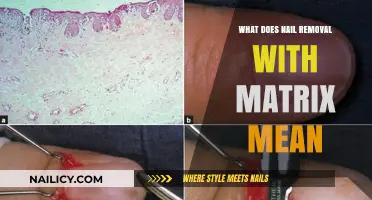 Matrix Nail Removal: What Does It Mean?