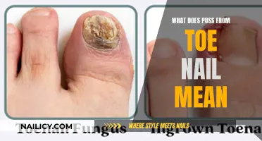 Unraveling the Mystery: What Does 'Puss from Toe Nail' Mean?