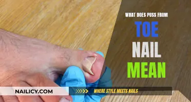Toe Nail Puss: What Does It Mean?