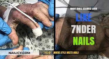 Scabies Under Nails: Identifying Symptoms and Appearance Explained