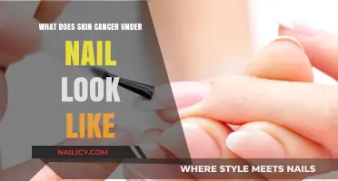 Recognizing Skin Cancer Under Nails: Symptoms, Appearance, and Early Detection
