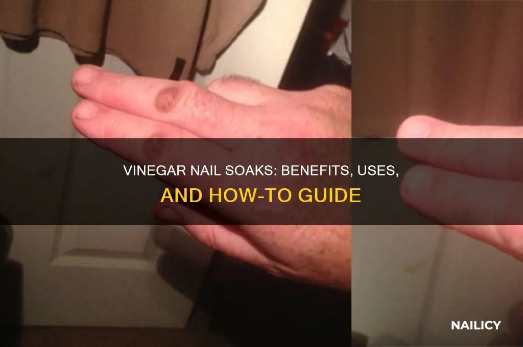 what does soaking nails in vinegar do