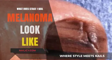 Early Signs of Nail Melanoma: Identifying Stage 1 Appearance