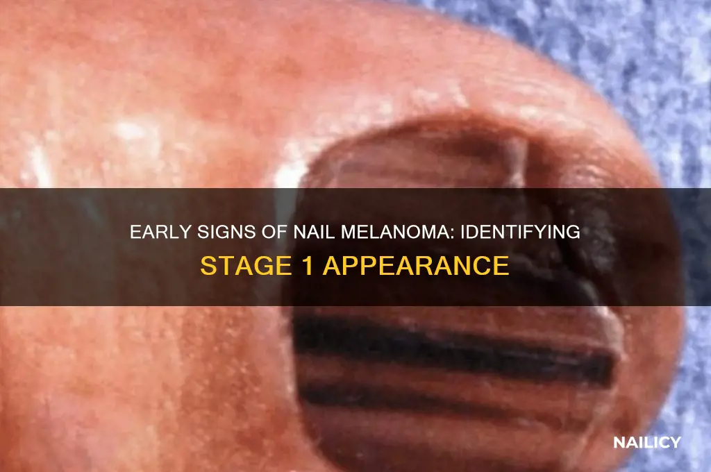 what does stage 1 nail melanoma look like