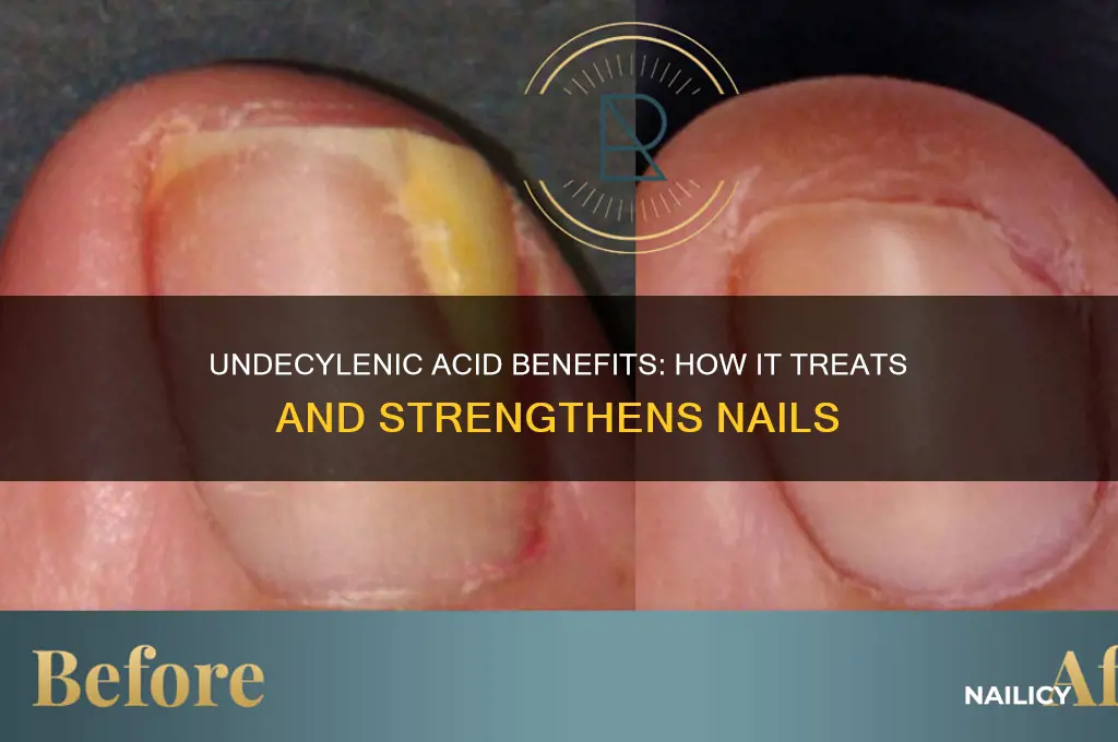 what does undecylenic acid do to nails