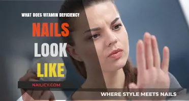 Vitamin Deficiency Nails: Recognizing Signs, Symptoms, and Solutions