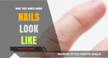 Understanding Nail Warts: Appearance, Symptoms, and Treatment Options Explained