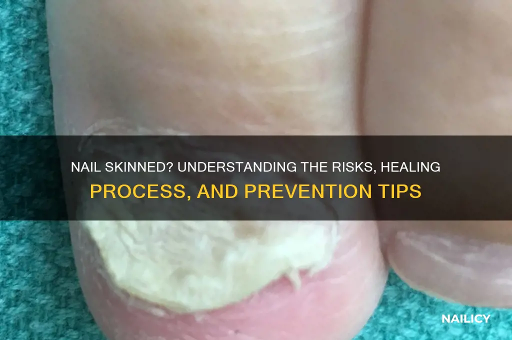 what happens if a nail skins you