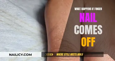 Ouch! What to Do When Your Fingernail Comes Off