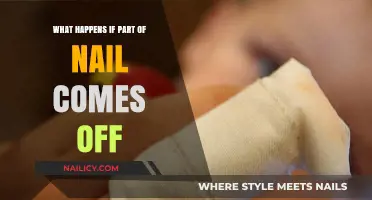 Nail Trauma: What to Do When Part of Your Nail Comes Off