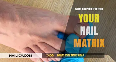 Torn Nail Matrix: Causes, Symptoms, and Recovery Explained