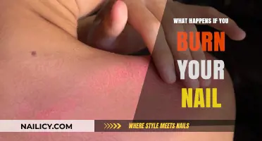 Burning Your Nail: Pain, Damage, and Recovery Explained