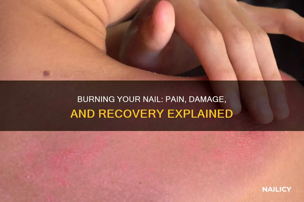 what happens if you burn your nail