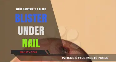 Blood Blister Under Nail: Causes, Treatment, and Healing Process Explained