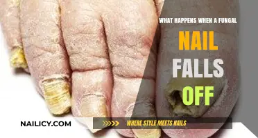 Fungal Nail Falls Off: What to Expect and How to Heal