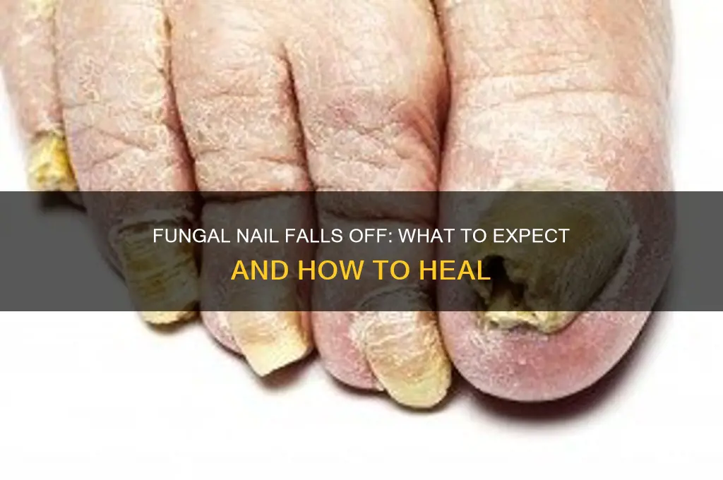 what happens when a fungal nail falls off
