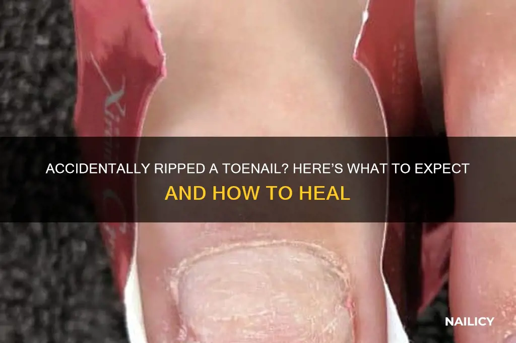 what happens when you accidntally rip atoe nail