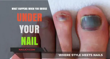 Understanding Subungual Hematoma: Causes, Symptoms, and Treatment Options