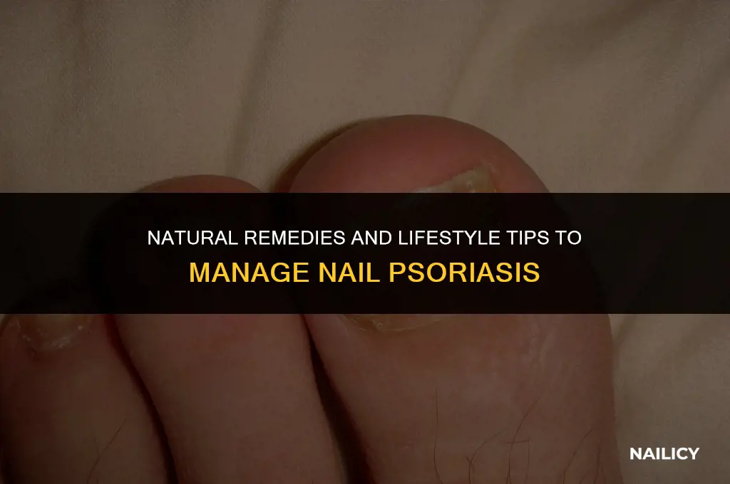 what helps nail psoriasis