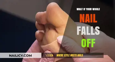 Nail Trauma: What to Do When Your Entire Nail Falls Off