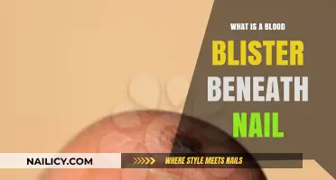 Understanding Painful Blood Blisters Underneath Fingernails and Toenails