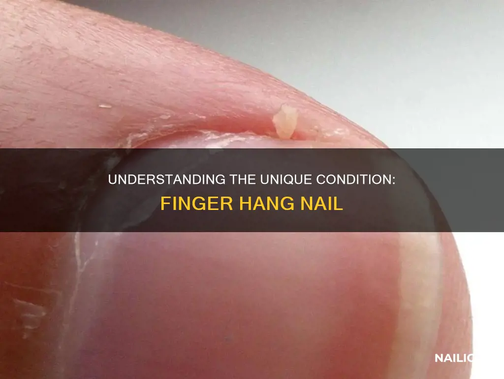 what is a finger hang nail