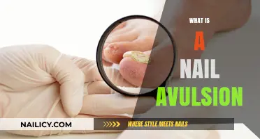 Understanding Nail Avulsion: Causes, Treatment, and Recovery Explained