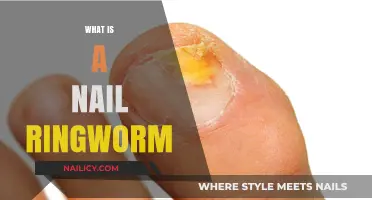 Understanding Nail Ringworm: Causes, Symptoms, and Effective Treatment Options