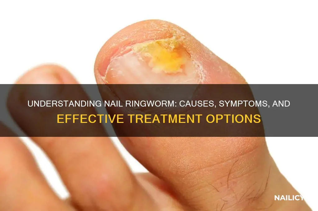 what is a nail ringworm