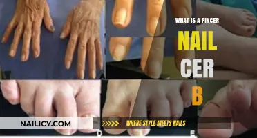 Understanding Pincer Nail Cer B: Causes, Symptoms, and Treatment Options