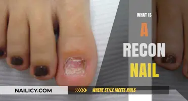 Understanding Recon Nails: Purpose, Procedure, and Post-Surgery Care