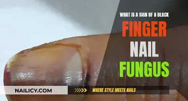 Black Fingernail: Signs of Fungal Infection