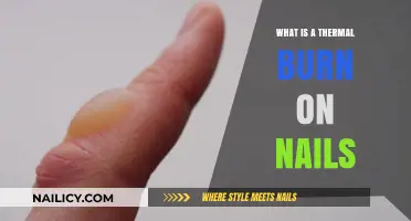 Understanding Thermal Burns on Nails: Causes, Symptoms, and Treatment Options