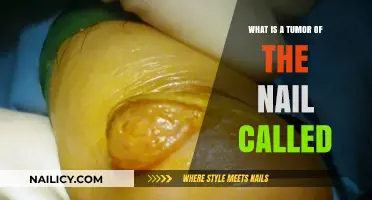 Understanding Subungual Exostosis: The Nail Tumor Explained Simply