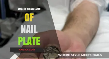 Understanding Nail Plate Avulsion: Causes, Symptoms, and Treatment Options