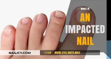 Understanding Impacted Nails: Causes, Symptoms, and Effective Treatment Options