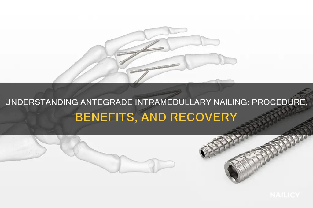 what is antegrade intramedullary nail