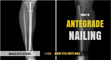 Understanding Antegrade Nailing: A Comprehensive Guide to Femur Fracture Treatment