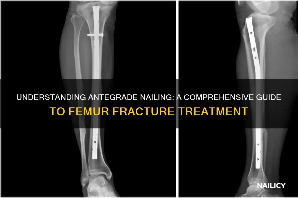 what is antegrade nailing