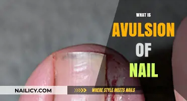 Understanding Avulsion of Nail: Causes, Symptoms, and Treatment Options