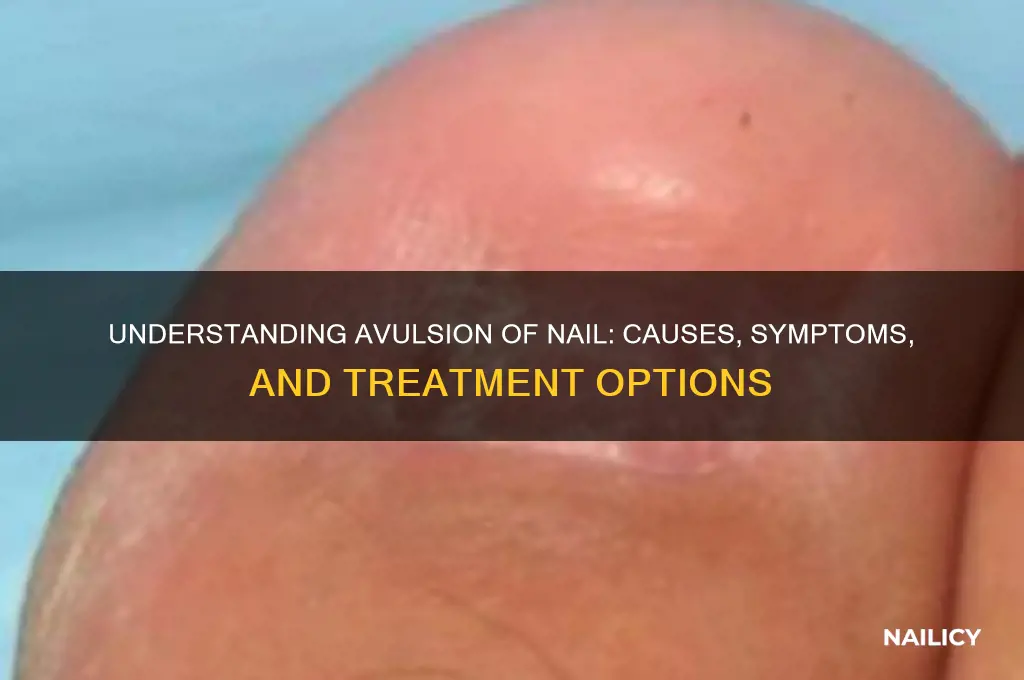 what is avulsion of nail