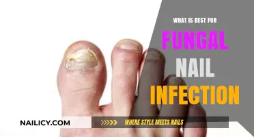 Effective Treatments for Fungal Nail Infections: Top Remedies and Prevention Tips
