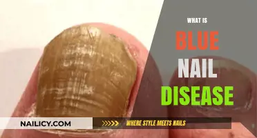 Understanding Blue Nail Disease: Causes, Symptoms, and Treatment Options