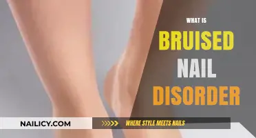 Understanding Bruised Nail Disorder: Causes, Symptoms, and Treatment Options