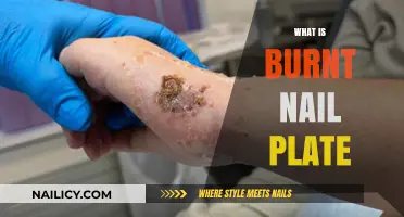 Understanding Burnt Nail Plate: Causes, Symptoms, and Treatment Options