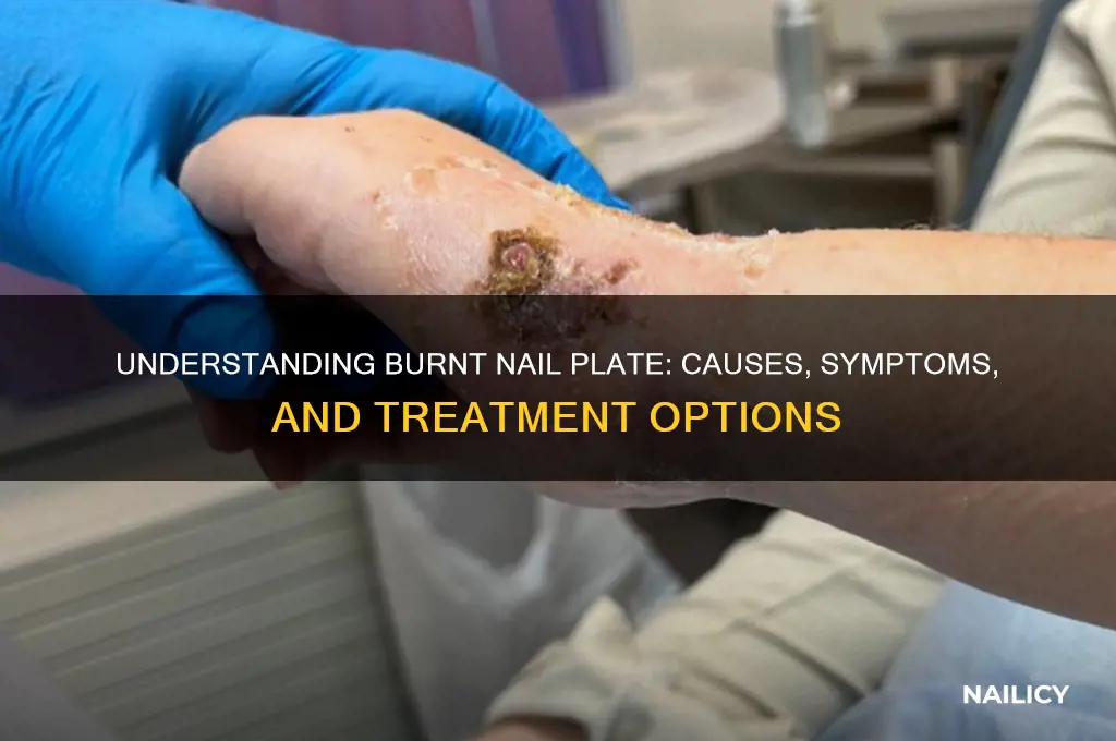 what is burnt nail plate